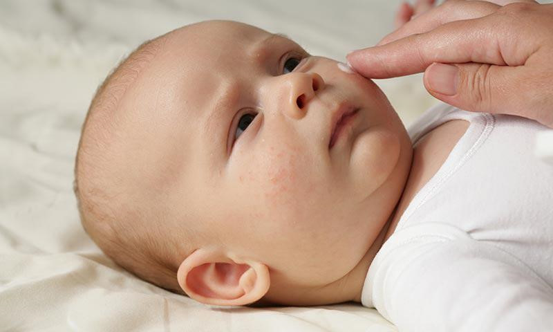 Dùng sữa mẹ để trị muỗi đốt cho bé cực kỳ hiệu quả