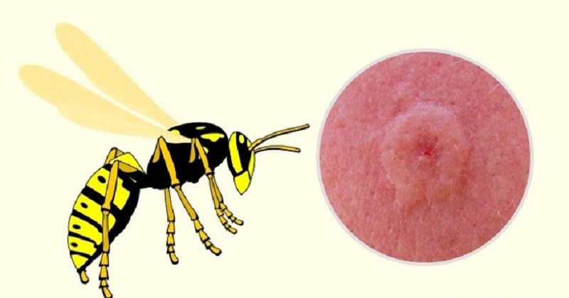 Vết đốt ong vò vẽ gây xuất huyết trên da